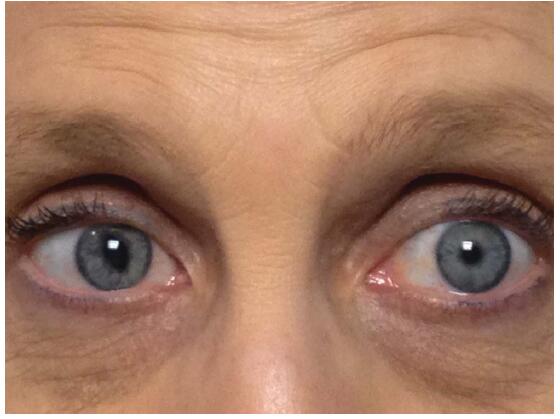 患者左侧瞳孔正常,右侧呈强直性猫眼瞳孔