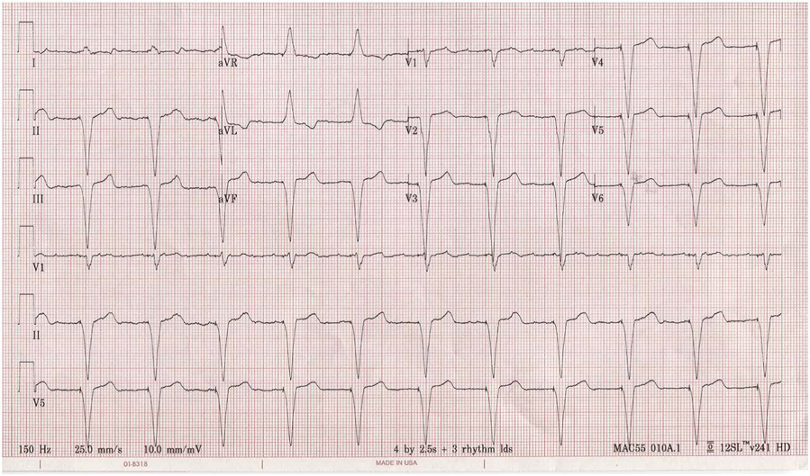 在口服负荷剂量的索他洛尔和经食道超声心动图后,进行直流电复律,再次