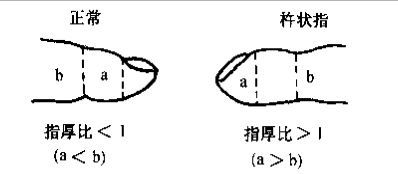 看似简单的杵状指,这些实用的重要内容你未必知道_杵