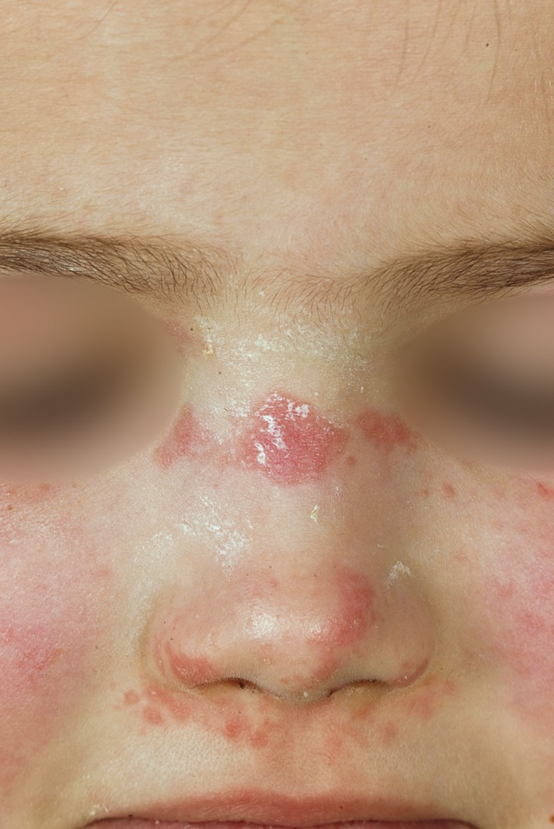 图1鼻部和面颊的皮肤有鳞屑的红斑