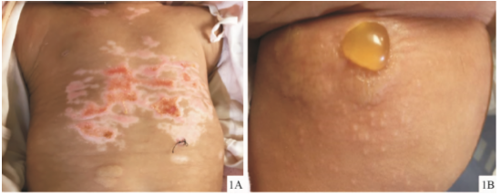 大疱型肥大细胞增生症患儿临床照片 1a: 胸部可见红斑,部分水疱