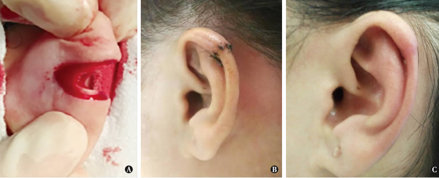手术切除与术后压力治疗耳郭瘢痕疙瘩1例