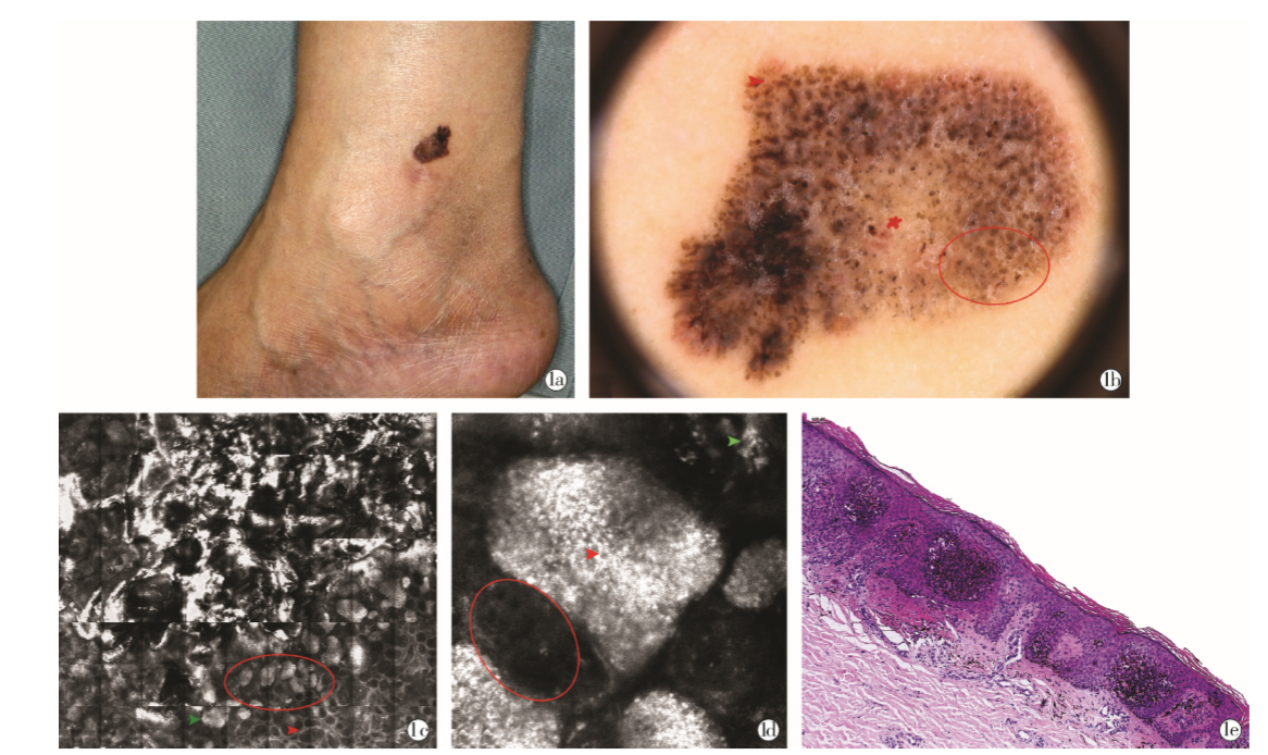 克隆型脂溢性角化病4 例皮肤镜及反射式共聚焦显微镜影像学特征及文献