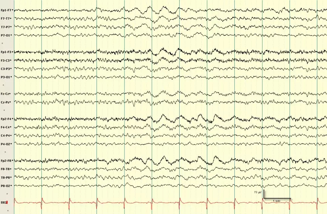 异常篇:最一目了然的成人脑电图图谱丨一键收藏