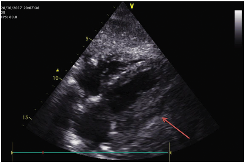 经胸超声心动图显示左室外侧壁附近有回声肿块