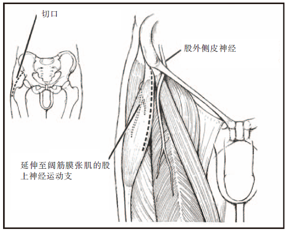 此神经一般在腹股沟韧带下方1cm,以及在韧带远端距同侧髂前上棘1.