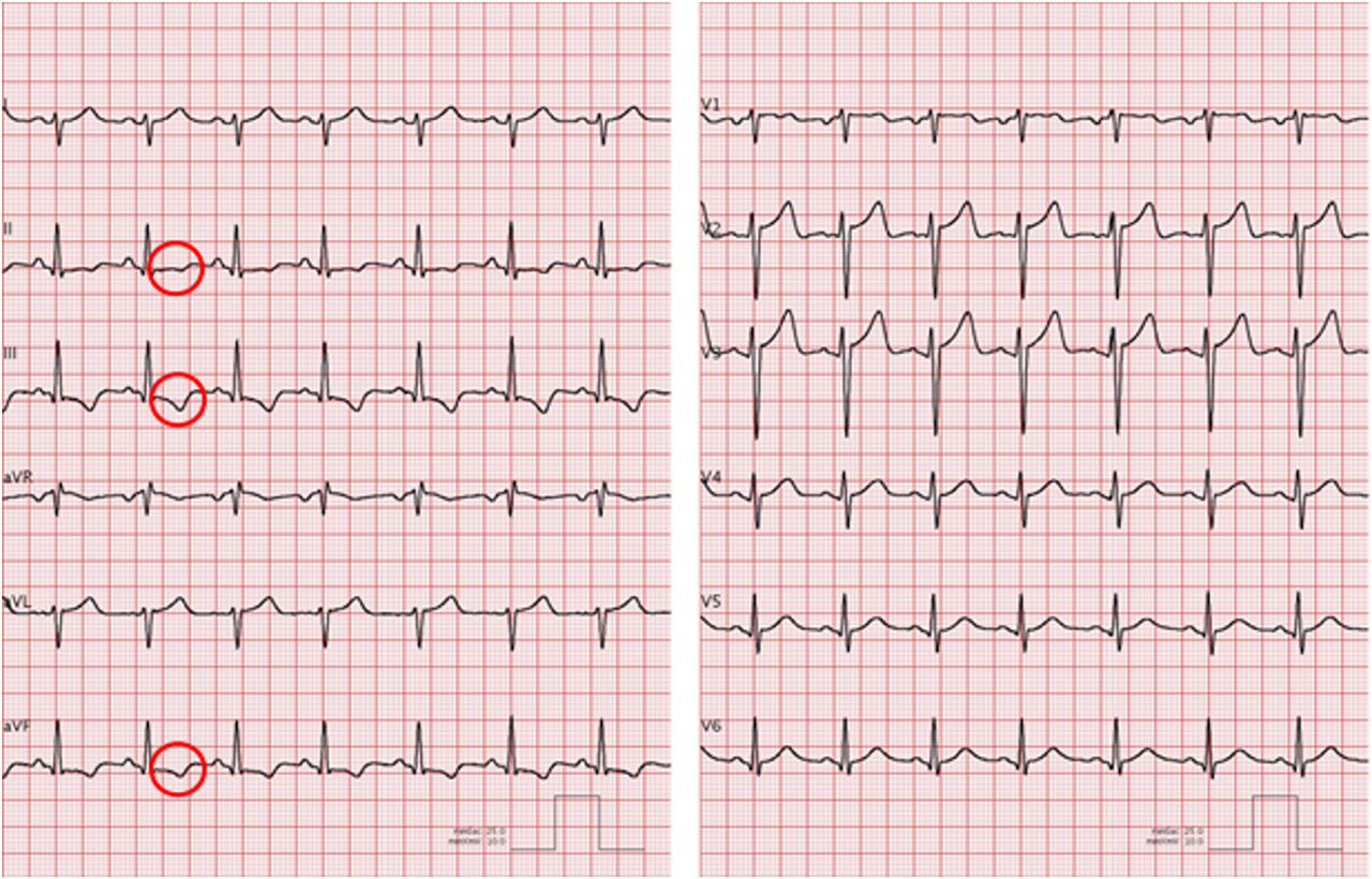 无症状t波倒置,谁是幕后黑手?|病例"心"编