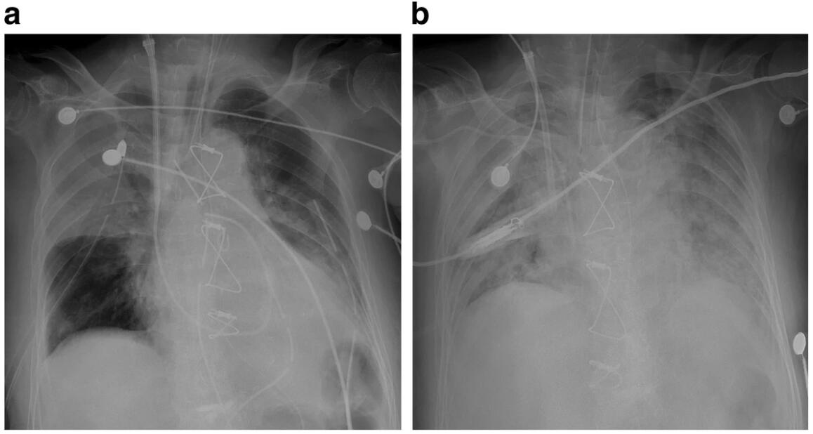 什么是动脉搭桥手术 1579597913544086.jpg