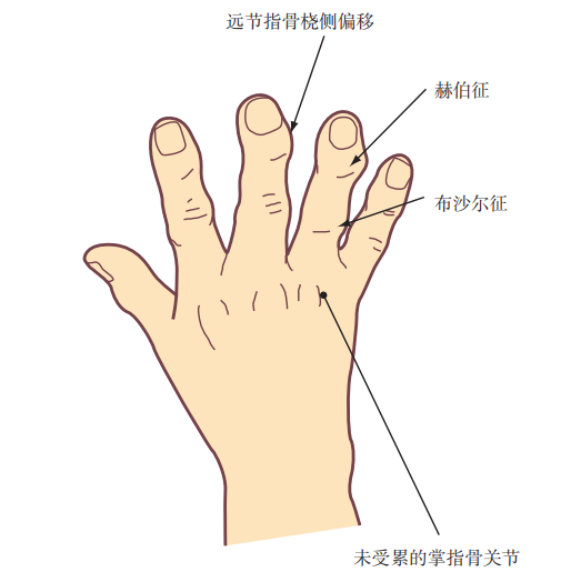 结晶性关节病变使oa病情变得更为复杂,尤其是在服用利尿药患者的手指