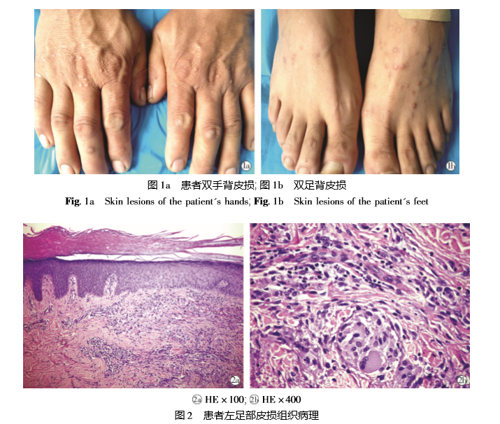局限性丘疹型环状肉芽肿1 例