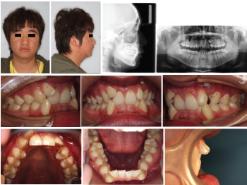 成人上颌尖牙阻生的内倾型深覆牙合拔牙矫治1例