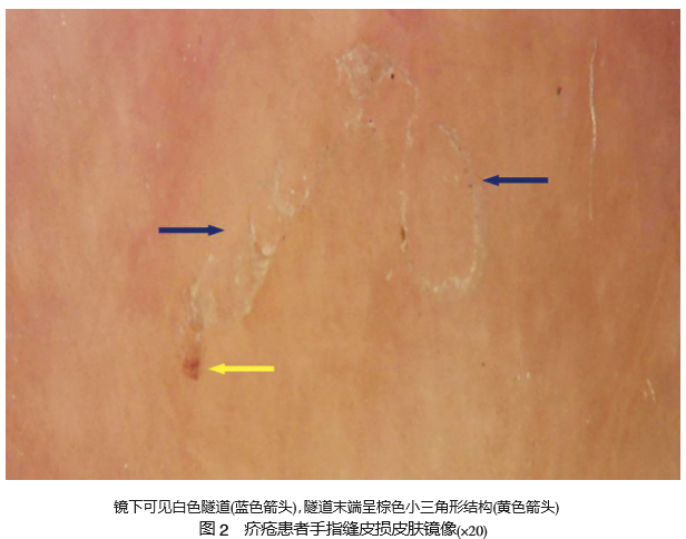 疥疮1例及皮肤镜表现