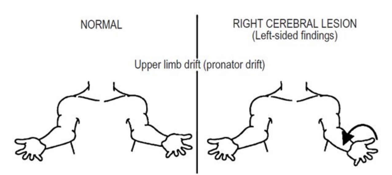 图9  前臂旋前试验结果解释(从远端到近端逐渐进展,逐步可见手臂下移
