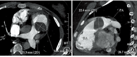 图1,2 心脏cta肺动脉瓣可见类圆形低密度充盈缺损区,病灶向右心室腔内