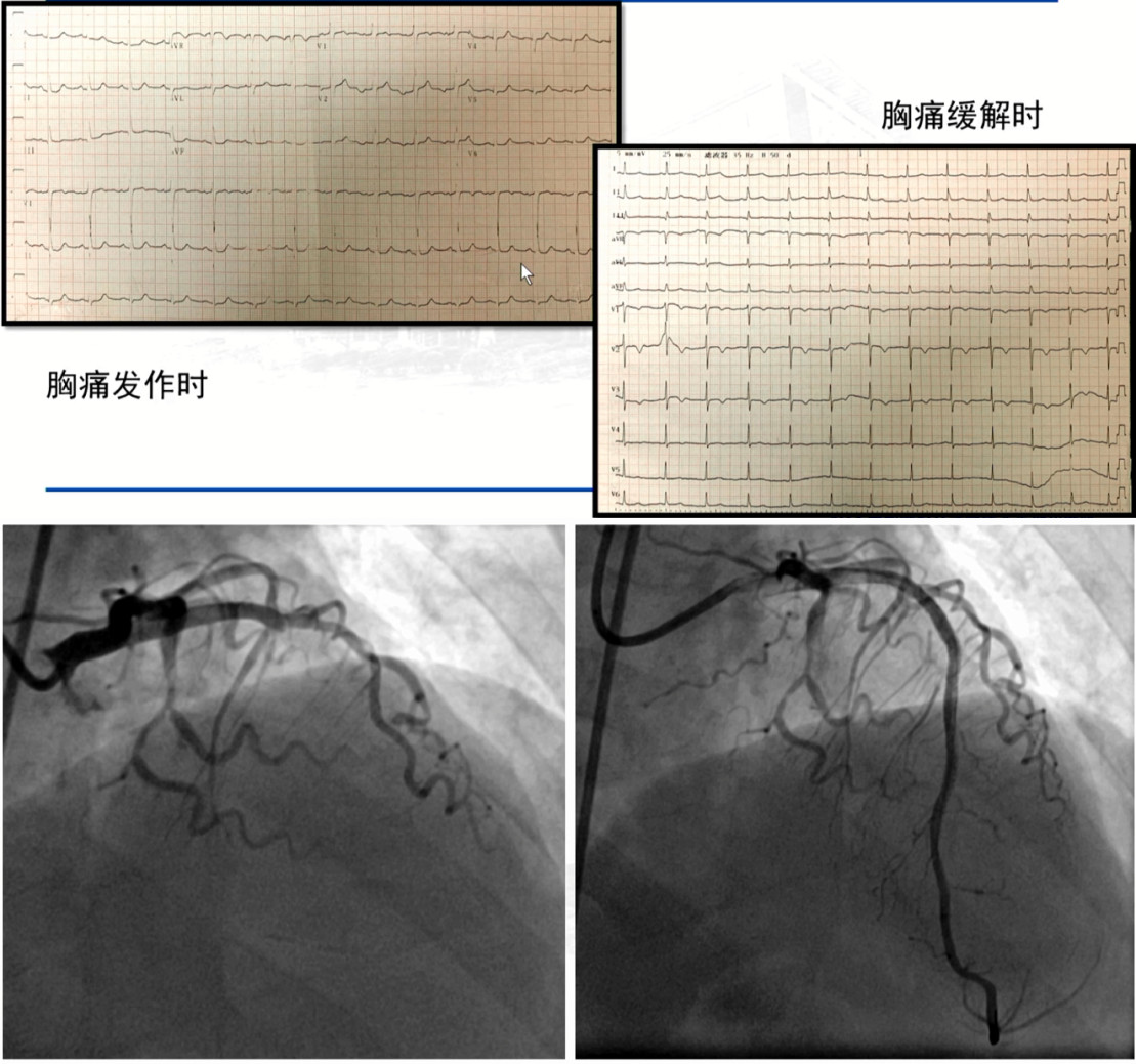 患者的心电图表现和冠脉造影图像