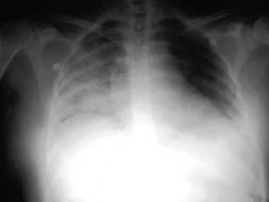 右肺大面积吸入性肺炎患者胸片