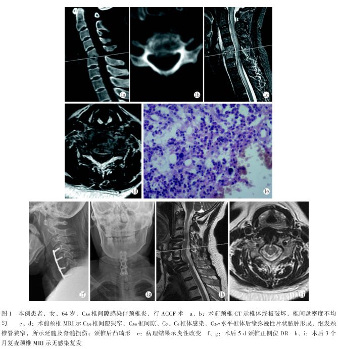 原发性颈椎间隙感染:1例报告及文献综述