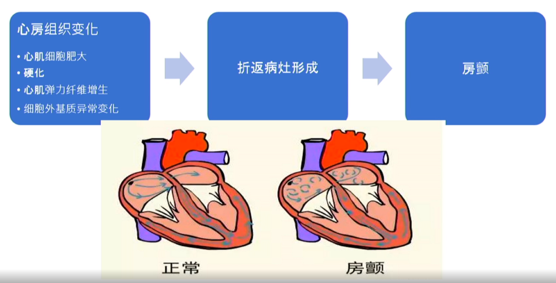 房颤发生的折返机制