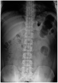 图1 病例1患者立位腹部x线平片示腹部肠腔积气扩张