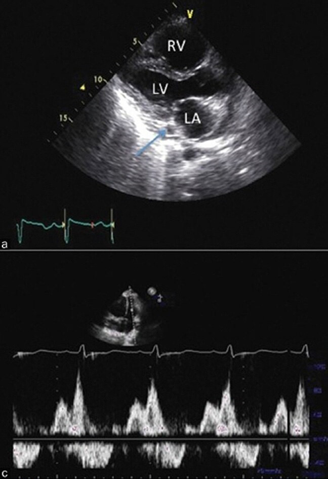 肺动脉高压患者的二维和多普勒超声心动图.