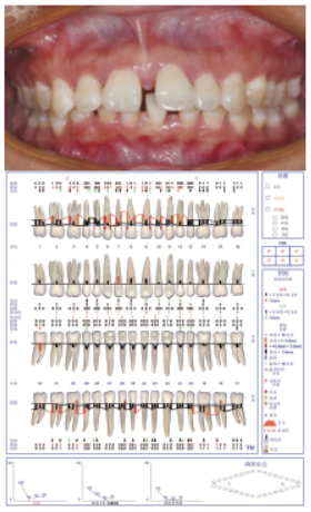 探诊深度大幅度减小,但7632112347651567仍有超过5mm的深牙周袋(图3)