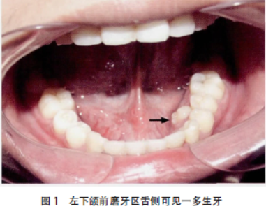 就诊指南  患者,男,17岁,主因发现左下颌一牙齿异位萌出6个月入院.