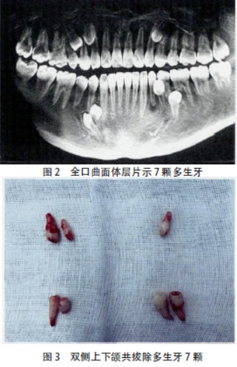 7颗多生牙报道1例及文献复习