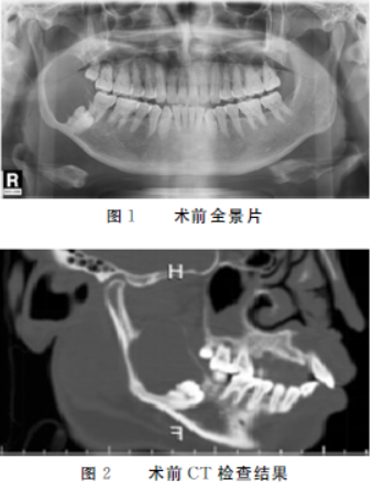 口内入路摘除治疗下颌骨巨大型颌骨囊肿1例及文献复习