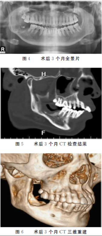 1 专科检查    右面颊肿大明显,口内扪及右侧下颌角区包块,张口度正常