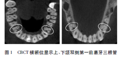 双侧上颌第一前磨牙3根3根管1例