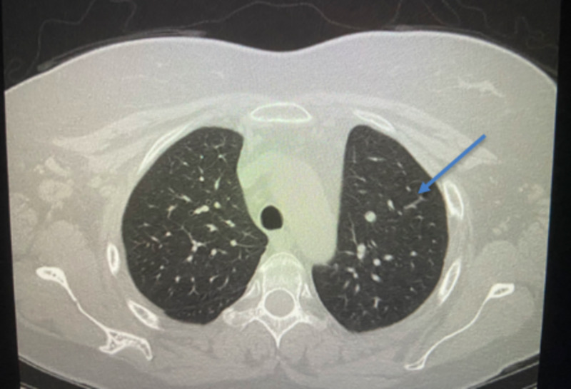 图2胸部ct扫描无对比显示正常肺实质.