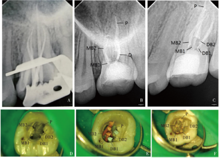 上颌第一磨牙远颊双根管1例