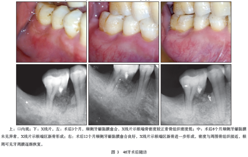 右侧下颌第一磨牙近中原发性牙根纵裂行活髓保存治疗1