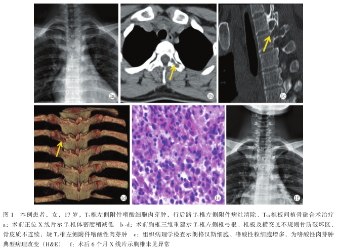 罕见胸椎附件单发骨嗜酸性肉芽肿1例