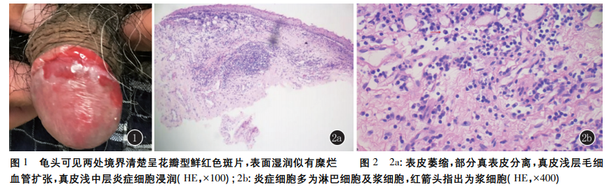 因龟头红斑 2 年,于 2019 年 5 月就诊于我科.