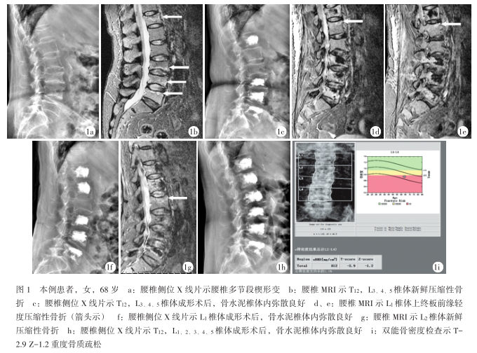 腰椎x线片示腰椎多节段楔形变(图1a),腰椎mri示t12,l3,4,5椎体新鲜