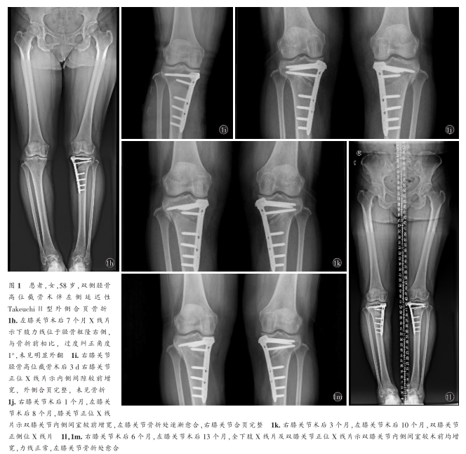 双侧胫骨高位截骨术伴左侧延迟性takeuchiⅡ型外侧合页骨折保守治疗1