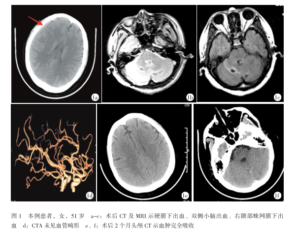 脊柱术后脑脊液漏伴颅内出血1例