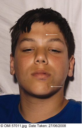 一名糖尿病儿童的带状硬皮病