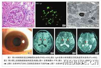 以尿检异常为首发症状的wilson病1例