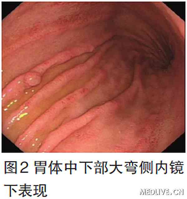 胃体中下部大弯侧内镜下表现