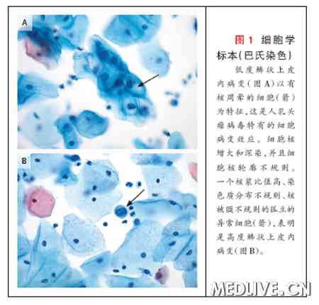 一位23岁的女性因巴氏(pap)涂片(宫颈细胞学检查)的病理检查可见高度