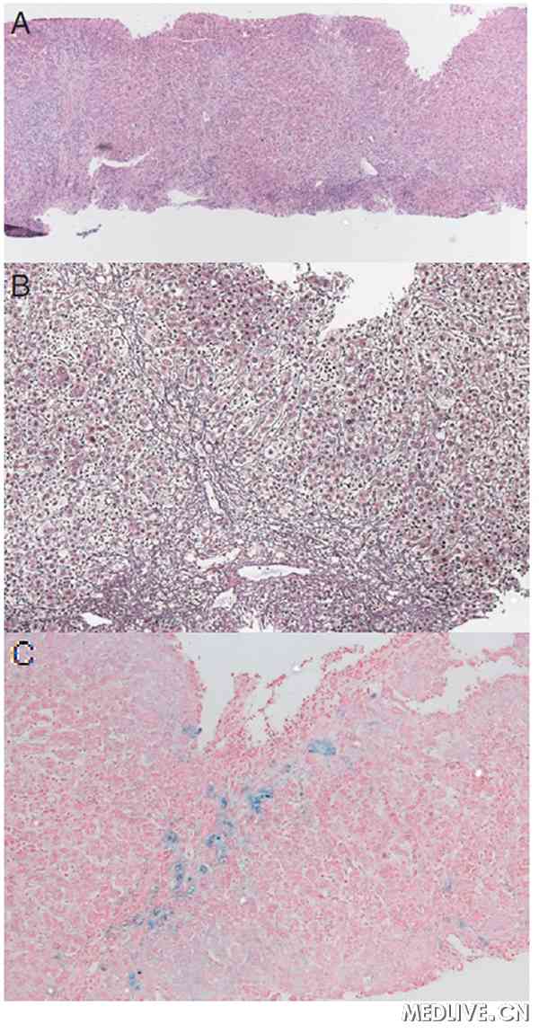 药物性肝炎组织病理学评分探讨并病例报告