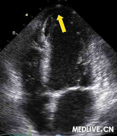 图2 超声心动图结果 左心室心尖部无运动(箭头)