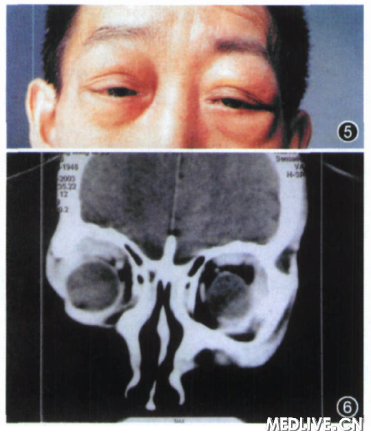 泪腺炎性假瘤图片图片