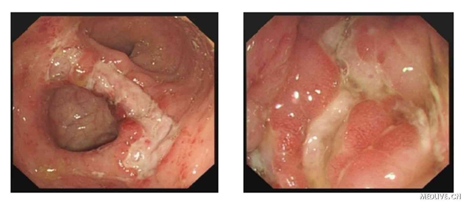 直肠溃疡肠镜图片图片