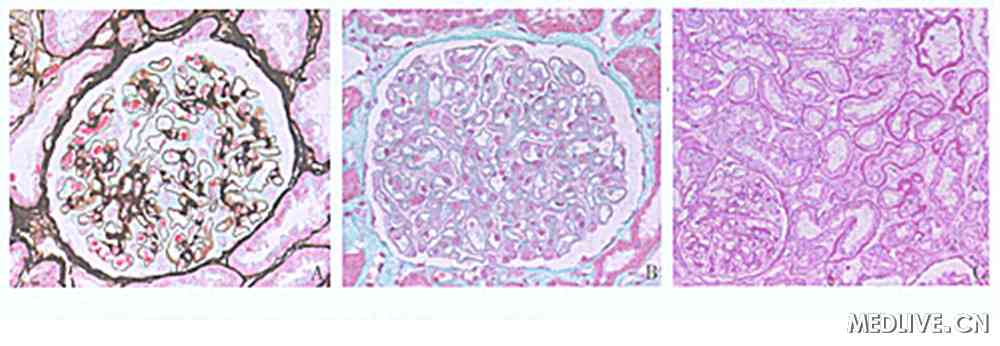 a:肾小球毛细血管袢开放僵硬状,上皮侧钉突形成(pasm-masson