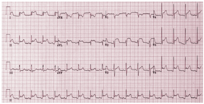 心電圖示廣泛導聯的凹陷性st段抬高,而avr導聯的st段壓低