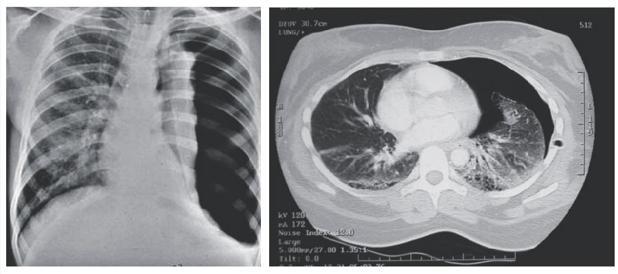 胸部x线片及胸部ct肺窗可见左侧胸膜腔气胸透过度增强,肺组织被