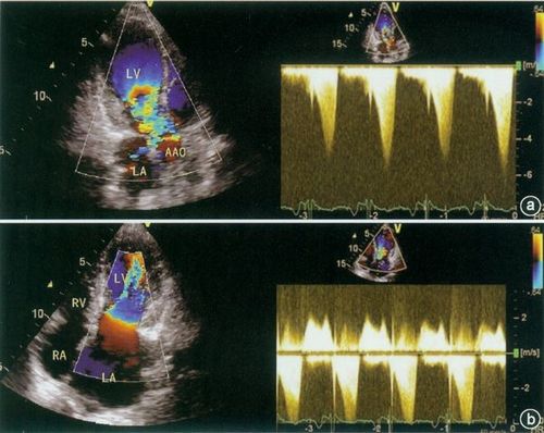患者超声心动图检测结果